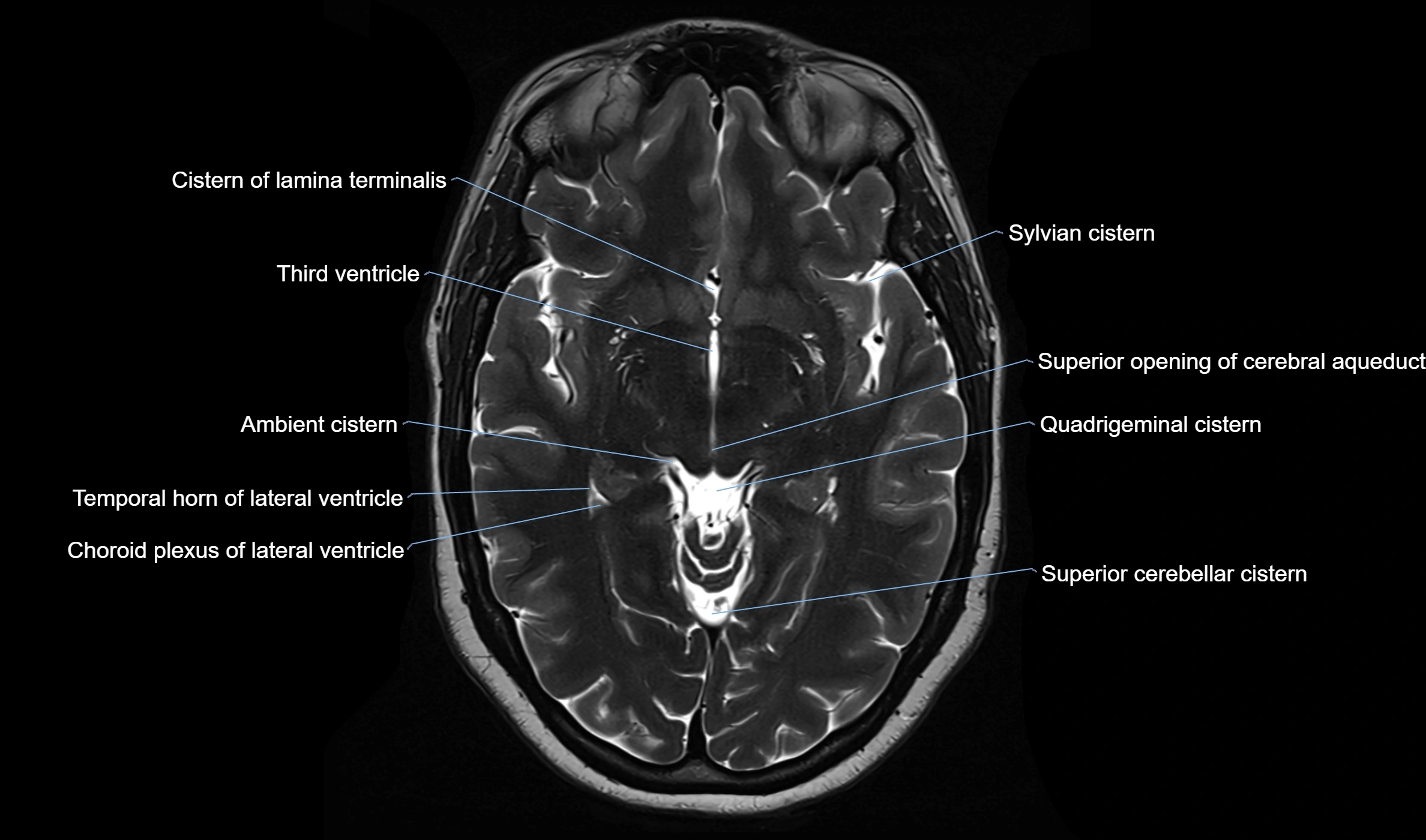 Brain cisterns  and ventricles  axial anatomy 3T MRI image-img-00001-00025.webp